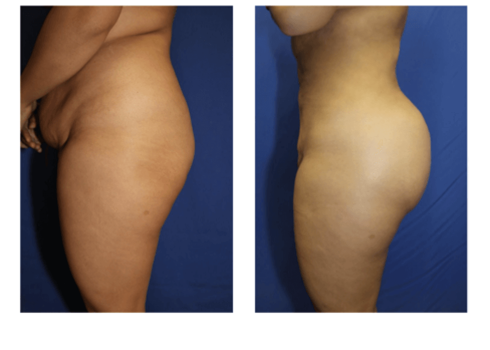 fat transfer before and after